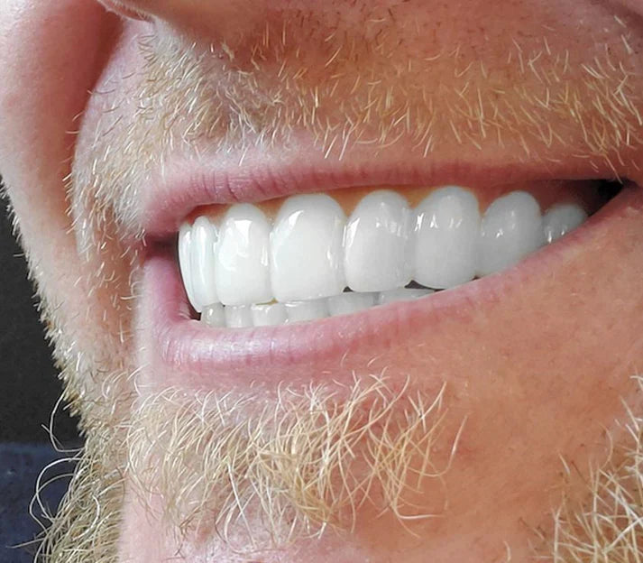 SMILEFLEX™ | CARILLAS DENTALES DE CERÁMICA