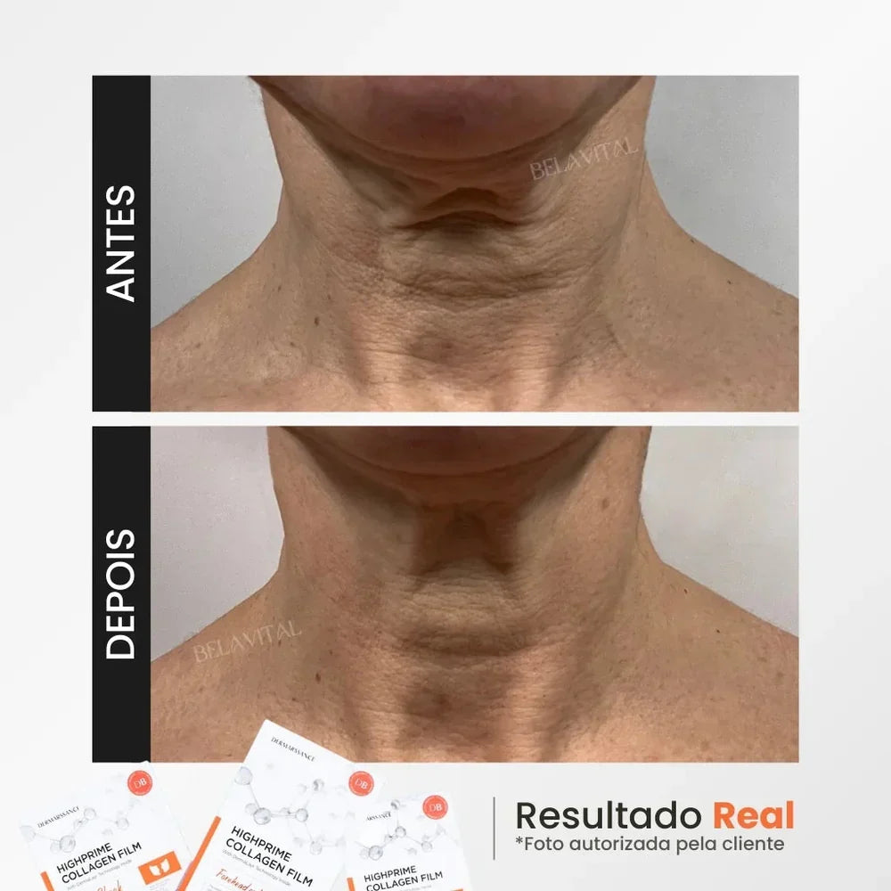 HIGHPRIME™ GOLDBOTOX | KIT DE COLÁGENO, ÁCIDO HIALURÓNICO Y EFECTO BOTOX