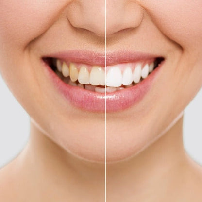 SMILE WHITE™ | LÁPIZ BLANQUEADOR DENTAL